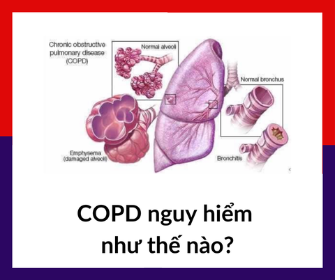 TẠI SAO MẮC COPD LẠI NGUY HIỂM ĐẾN TÍNH MẠNG?| Wellbeing