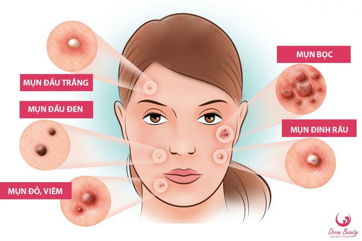 TOPIC 02: NHỮNG ĐIỀU CẦN BIẾT ĐỂ TRỊ DỨT ĐIỂM MỤN ( NGUYÊN NHÂN, PHÂN LOẠI, CÁCH ĐIỀU TRỊ )