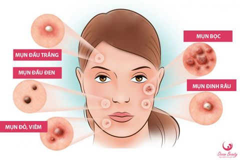 TOPIC 02: NHỮNG ĐIỀU CẦN BIẾT ĐỂ TRỊ DỨT ĐIỂM MỤN ( NGUYÊN NHÂN, PHÂN LOẠI, CÁCH ĐIỀU TRỊ )