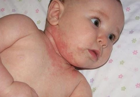 Trẻ sơ sinh bị nổi mẩn đỏ ở cổ có nguy hiểm không?