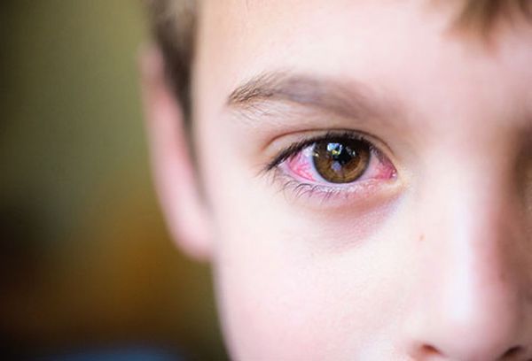 Đau mắt đỏ có thể là triệu chứng của COVID-19?