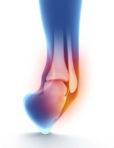 5 bước phục hồi lật cổ chân nhanh và hiệu quả