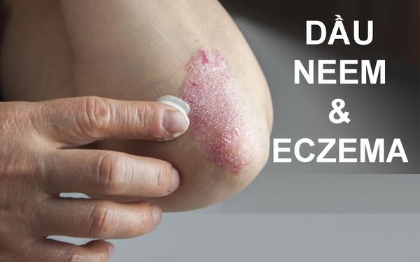 Dầu Neem và bệnh Chàm (Eczema) - Liệu pháp điều trị thảo dược tự nhiên