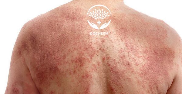 Neem, dầu Neem, Docneem, Neem chàm, Neem Eczema, Neem viêm da cơ địa, Neemcure, Soap Neem, Xà bông Neem