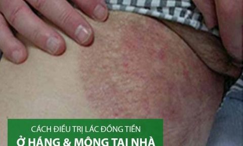 Tổng hợp các Cách điều trị lác đồng tiền tại nhà nhanh nhất, hiệu quả nhất