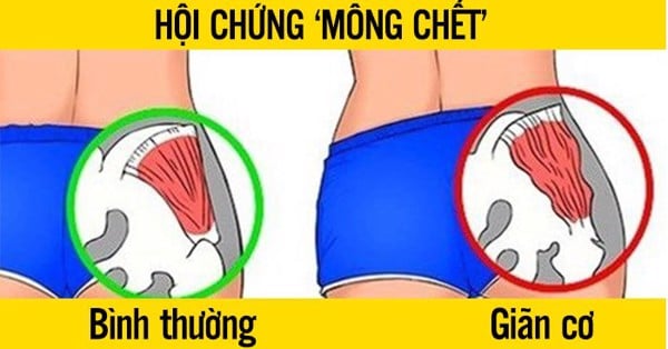 Hội chứng 