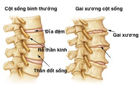 Bệnh gai cột sống: Nguyên nhân triệu chứng và cách điều trị