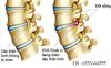 Tìm Hiểu Bệnh Thoát Vị Đĩa Đệm - Dấu Hiệu Và Cách Điều Trị‎