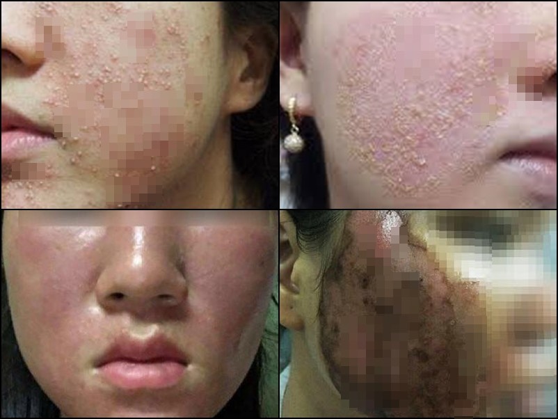 Cách chăm sóc phục hồi da nhiễm Corticoid