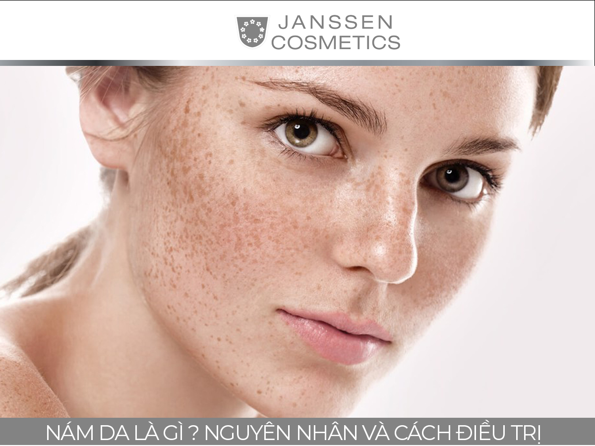 NÁM DA LÀ GÌ ? NGUYÊN NHÂN VÀ CÁCH ĐIỀU TRỊ