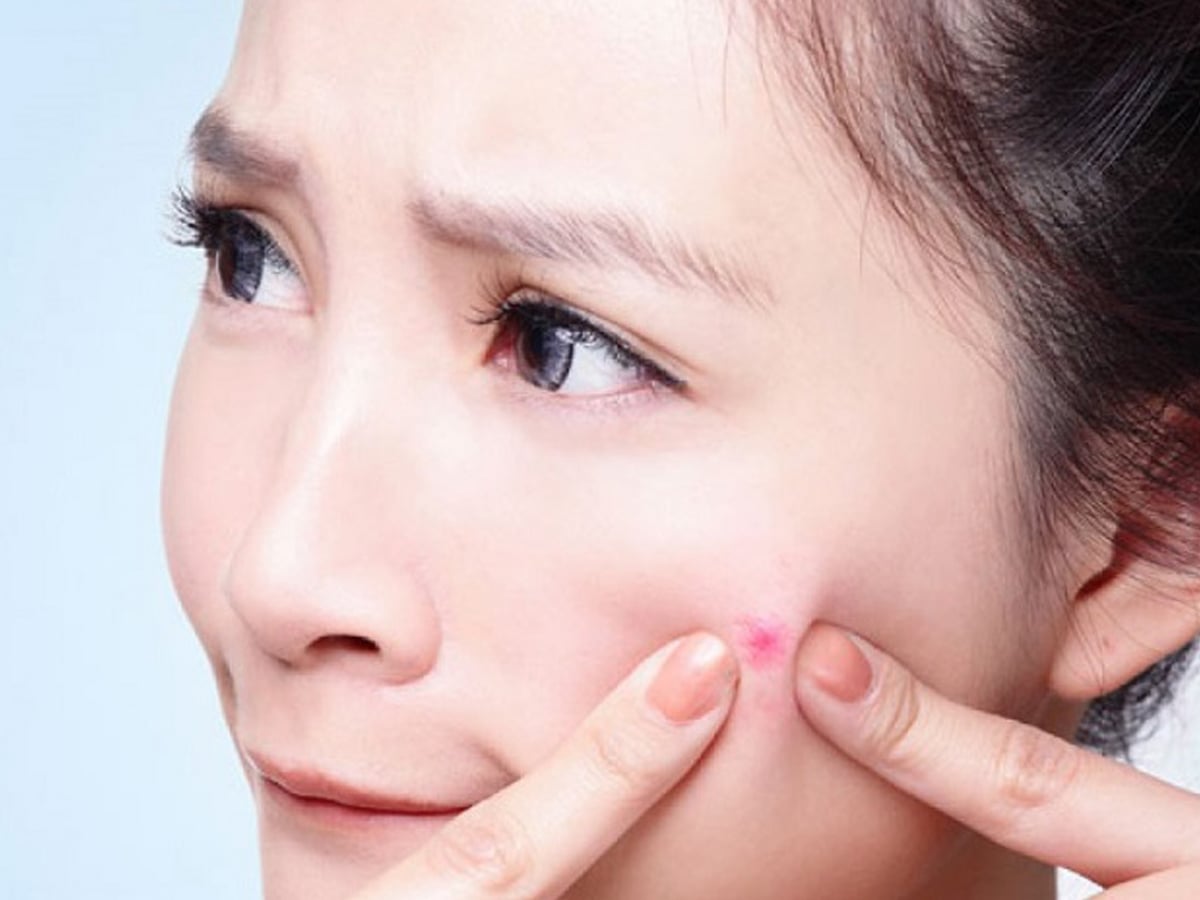 Nặn mụn xong làm gì để không bị thâm da mặt?