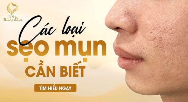 [ GÓC CHIA SẺ ] CÁC LOẠI SẸO MỤN THƯỜNG GẶP