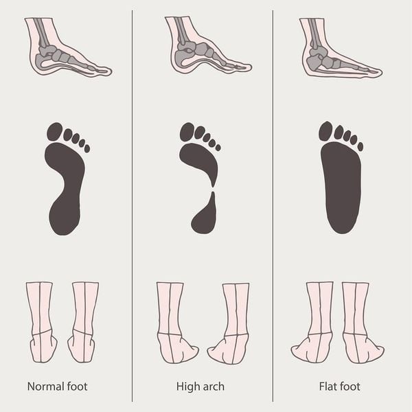 3 loại bàn chân phổ biến