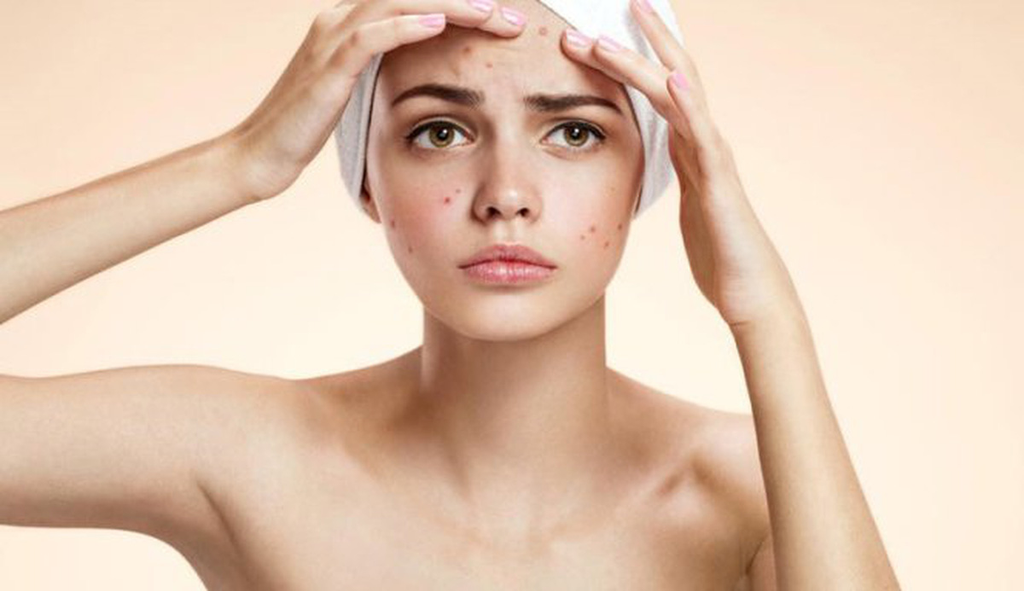 The story of people who have self-deprecation because of acne and the unexpected