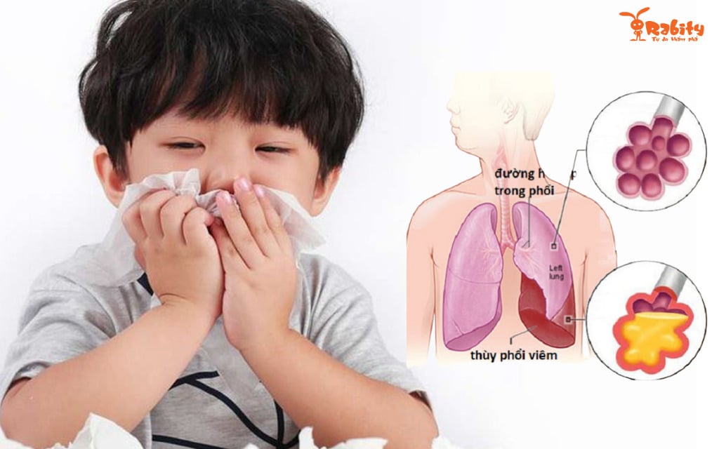 một số bệnh thường gặp ở trẻ mầm non viêm phổi
