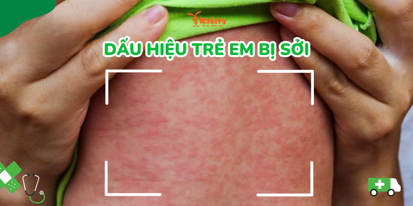 Dấu hiệu trẻ em bị sởi