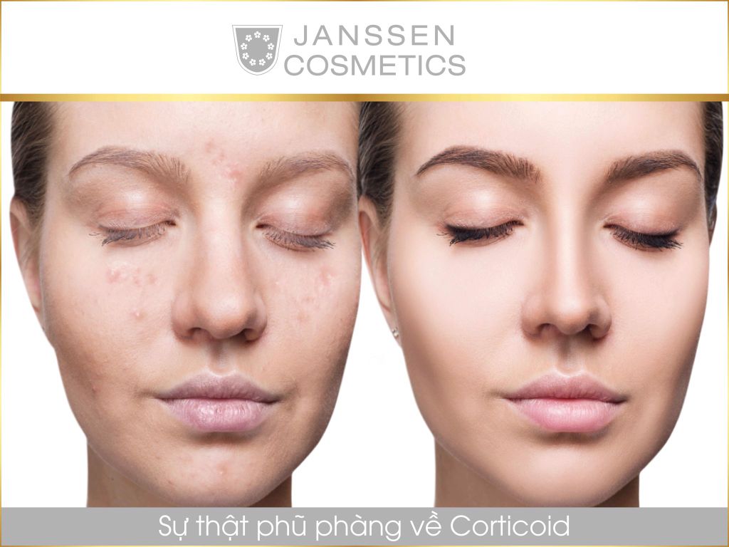 SỰ THẬT PHŨ PHÀNG VỀ CORTICOID