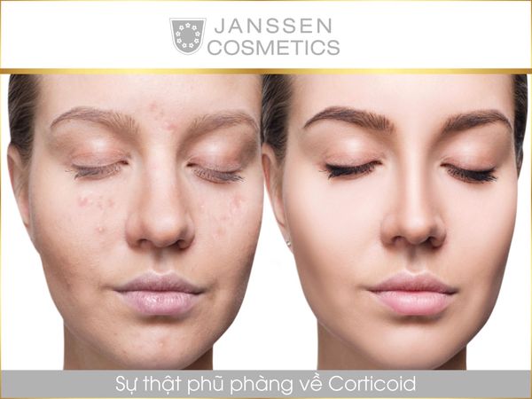 SỰ THẬT PHŨ PHÀNG VỀ CORTICOID