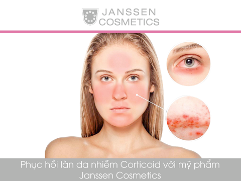 MỸ PHẨM JANSSEN GIÚP PHỤC HỒI LÀN DA NHIỄM CORTICOID