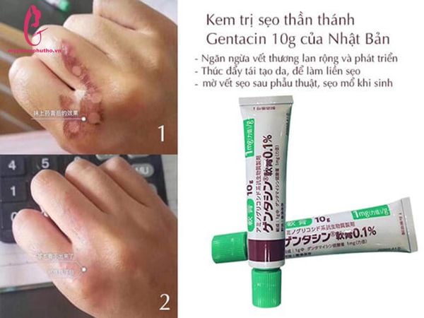 Kem trị sẹo GENTACIN Nhật Bản Lồi Lõm