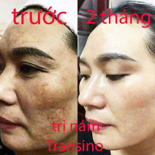 phản hồi khách hàng trị nám transino