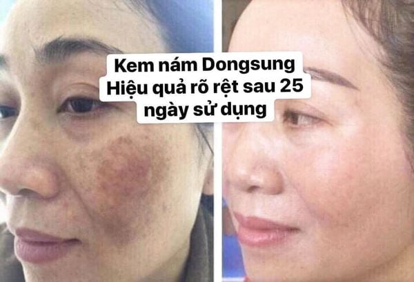 phản hồi khách hàng sau khi sử dụng bộ trị nám dongsung hàn quốc