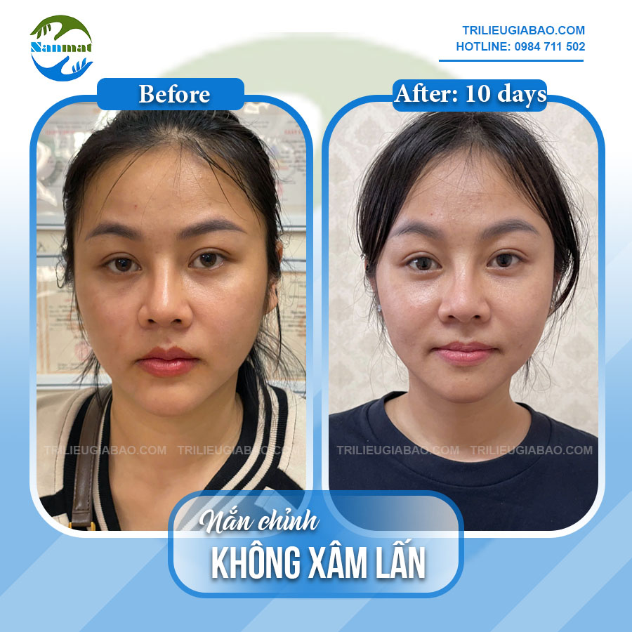 NẮN MẶT LỆCH KHÔNG XÂM LẤN: MS.VÂN ANH SAU 10 BUỔI NẮN CHỈNH