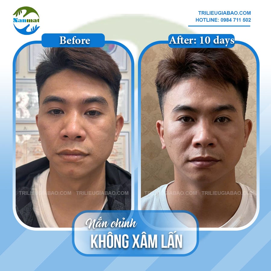 NẮN MẶT LỆCH KHÔNG XÂM LẤN: MR.NAM SAU 10 BUỔI NẮN CHỈNH