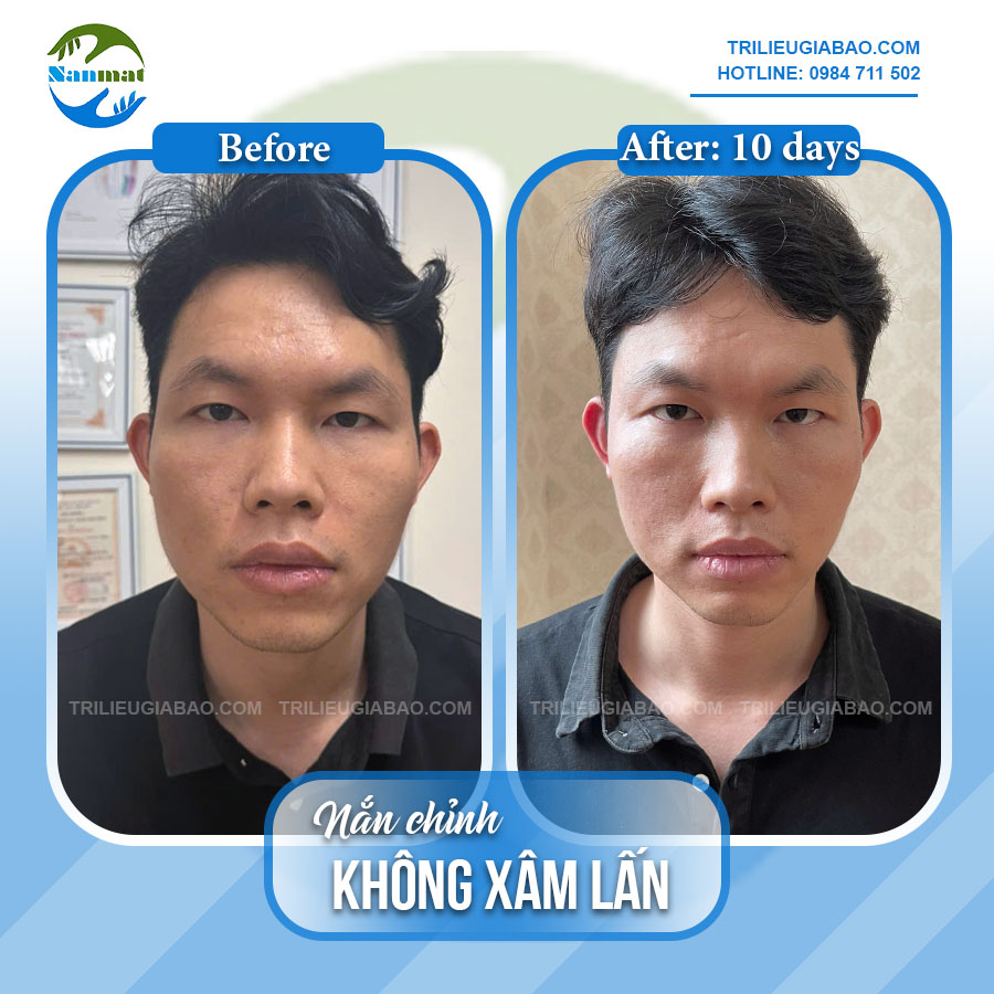 NẮN MẶT LỆCH KHÔNG XÂM LẤN: MS.TRANG SAU 10 BUỔI NẮN CHỈNH