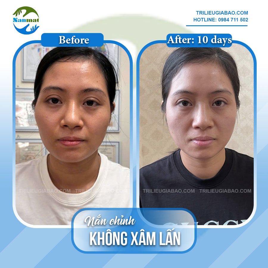 NẮN MẶT KHÔNG XÂM LẤN: MS.OANH SAU 10 BUỔI NẮN CHỈNH