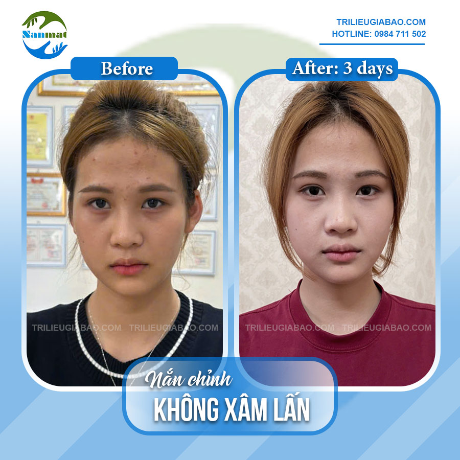 NẮN CHỈNH MẶT KHÔNG XÂM LẤN: MS.THẢO SAU 3 BUỔI CHUYÊN SÂU
