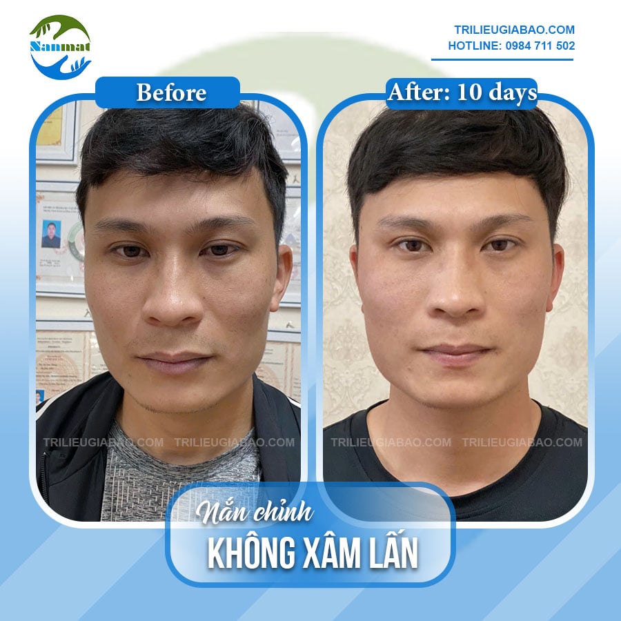 NẮN MẶT LỆCH KHÔNG XÂM LẤN: MS.HUYỀN SAU 10 BUỔI NẮN CHỈNH