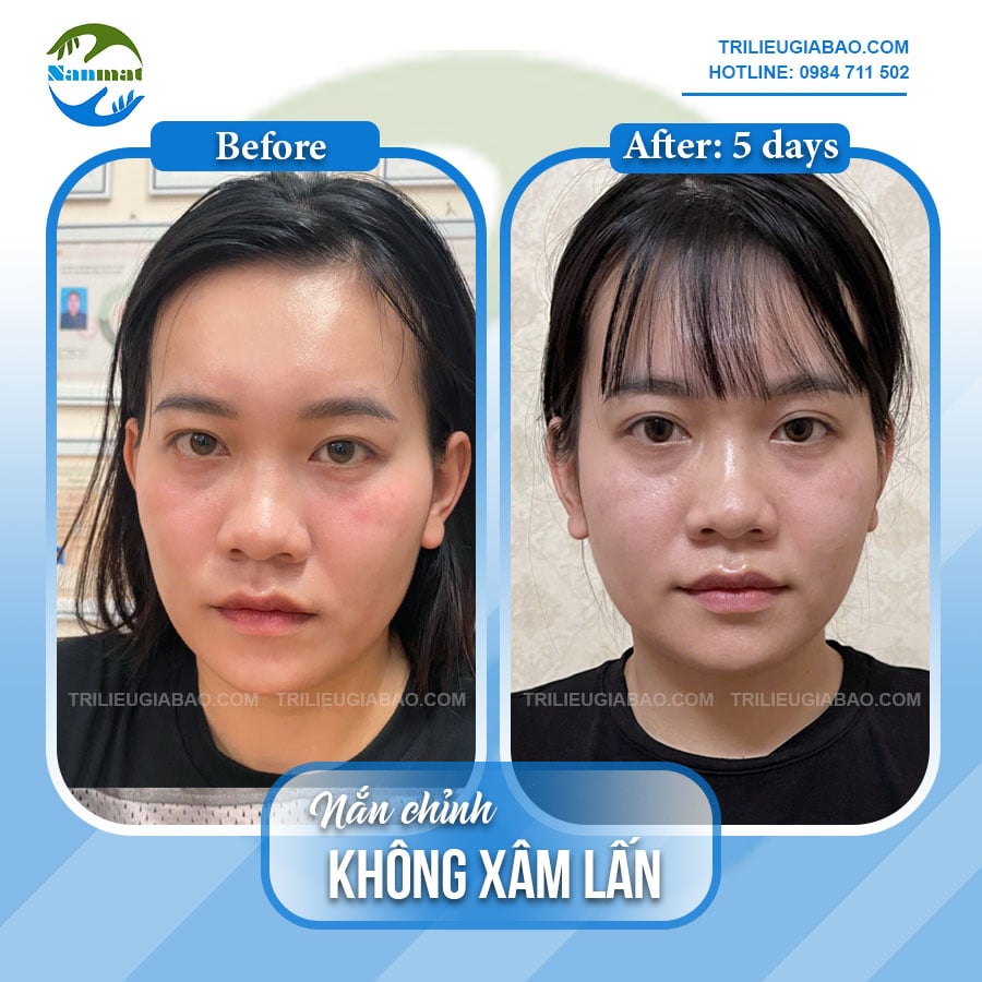 NẮN MẶT LỆCH KHÔNG XÂM LẤN: MS.DUNG SAU 5 BUỔI NẮN CHỈNH CHUYÊN SÂU