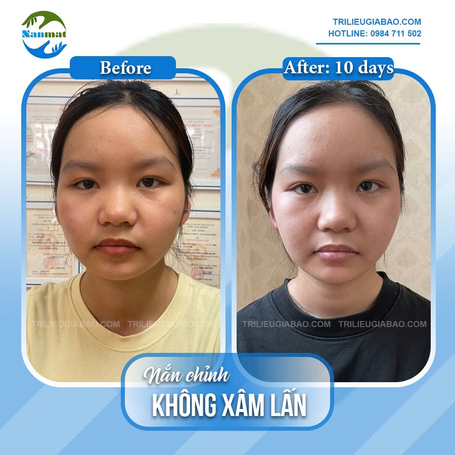 NẮN MẶT KHÔNG XÂM LẤN: MS.OANH SAU 10 BUỔI NẮN CHỈNH
