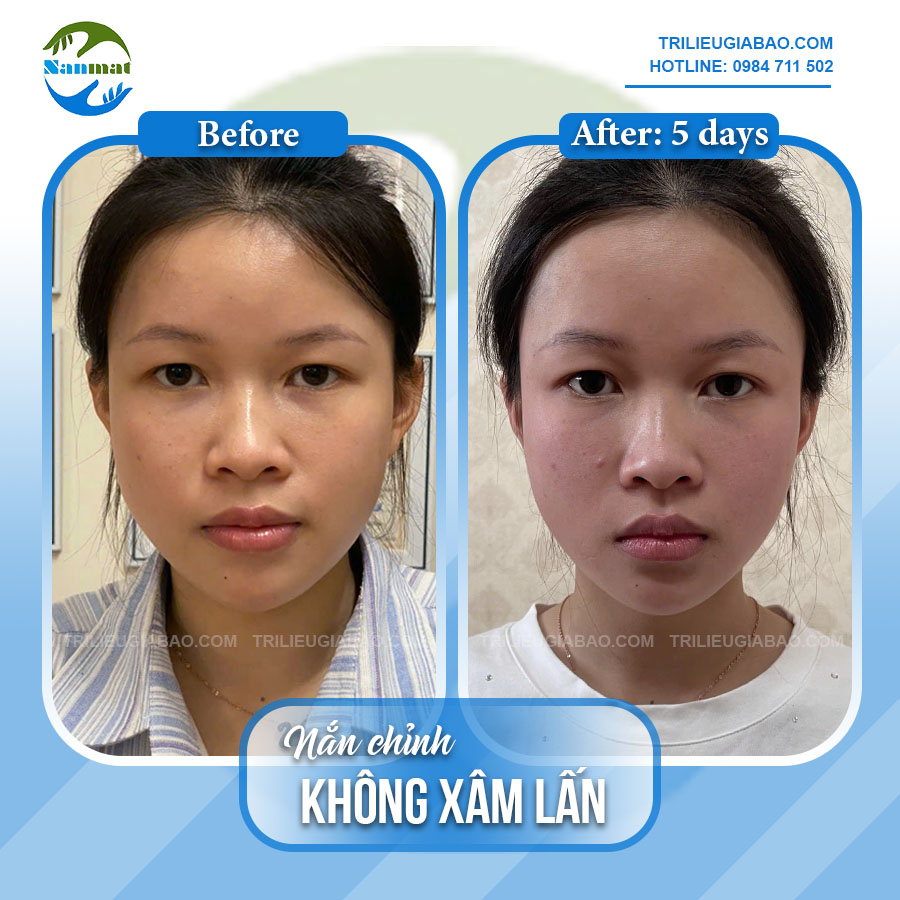 NẮN MẶT LỆCH KHÔNG XÂM LẤN: MS.DUNG SAU 5 BUỔI NẮN CHỈNH CHUYÊN SÂU