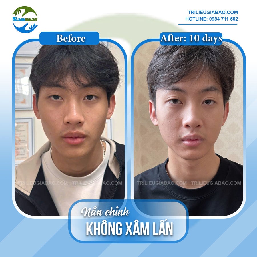 NẮN MẶT KHÔNG XÂM LẤN: MR.LINH SAU 10 BUỔI NẮN CHỈNH