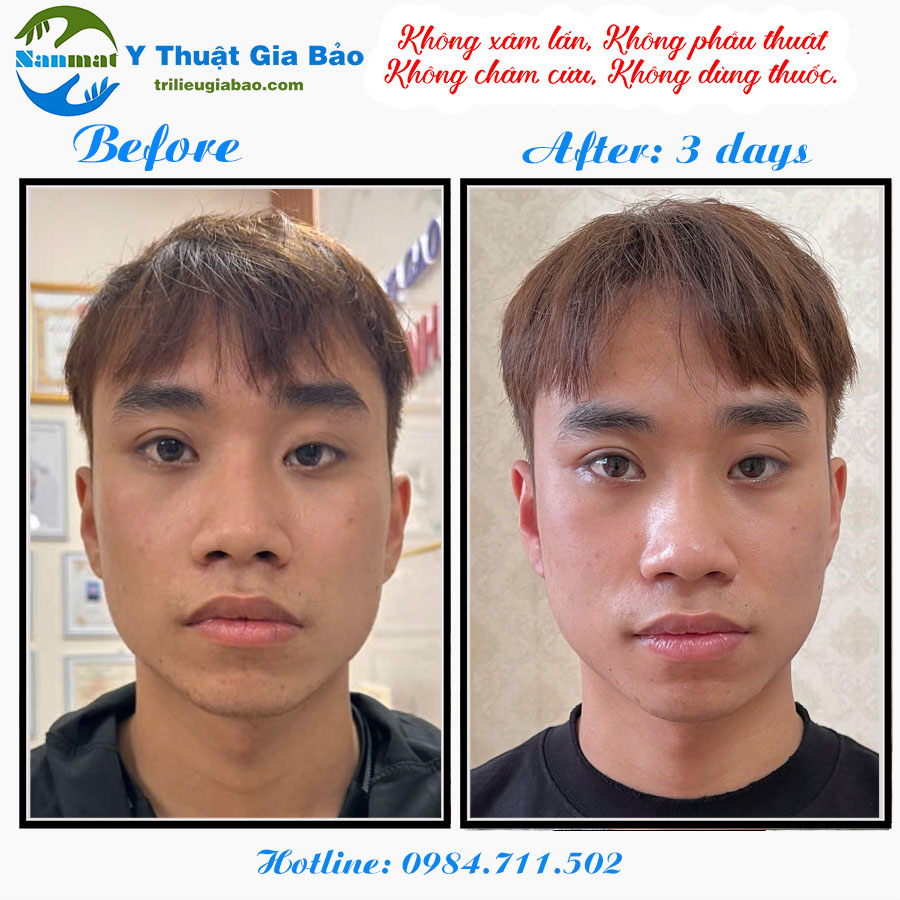 NẮN MẶT LỆCH KHÔNG XÂM LẤN: MS.HUYỀN SAU 3 BUỔI NẮN CHỈNH