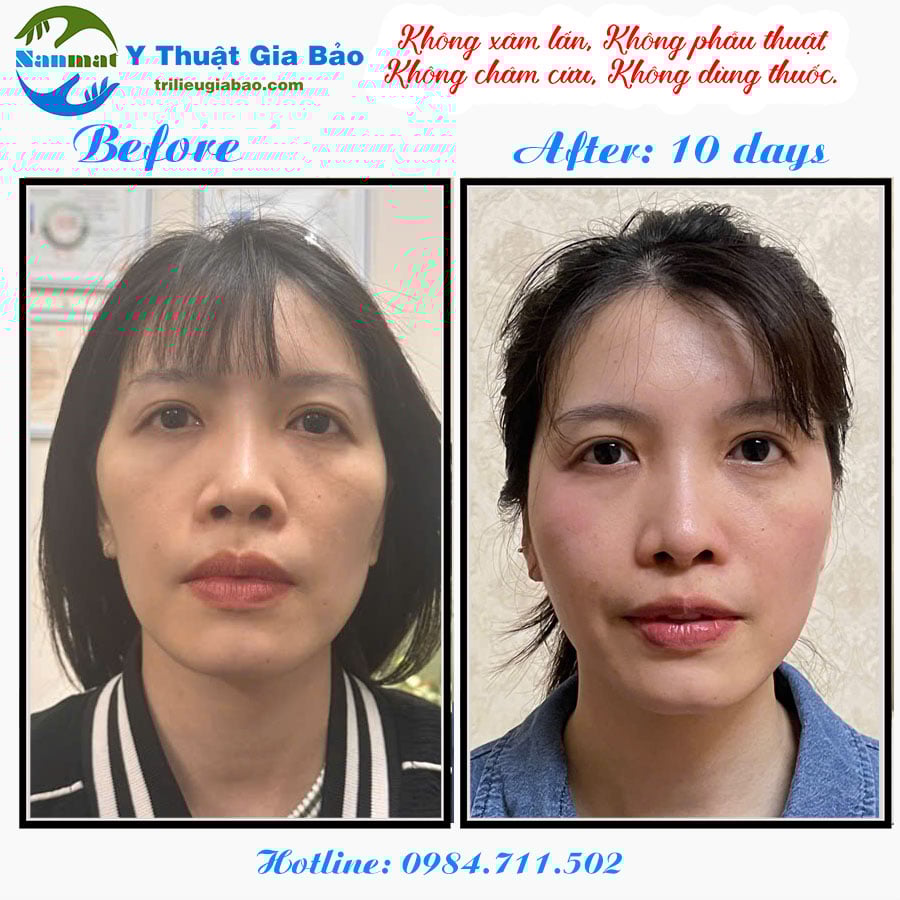 NẮN MẶT LỆCH KHÔNG XÂM LẤN: MS.MAI SAU 10 BUỔI NẮN CHỈNH
