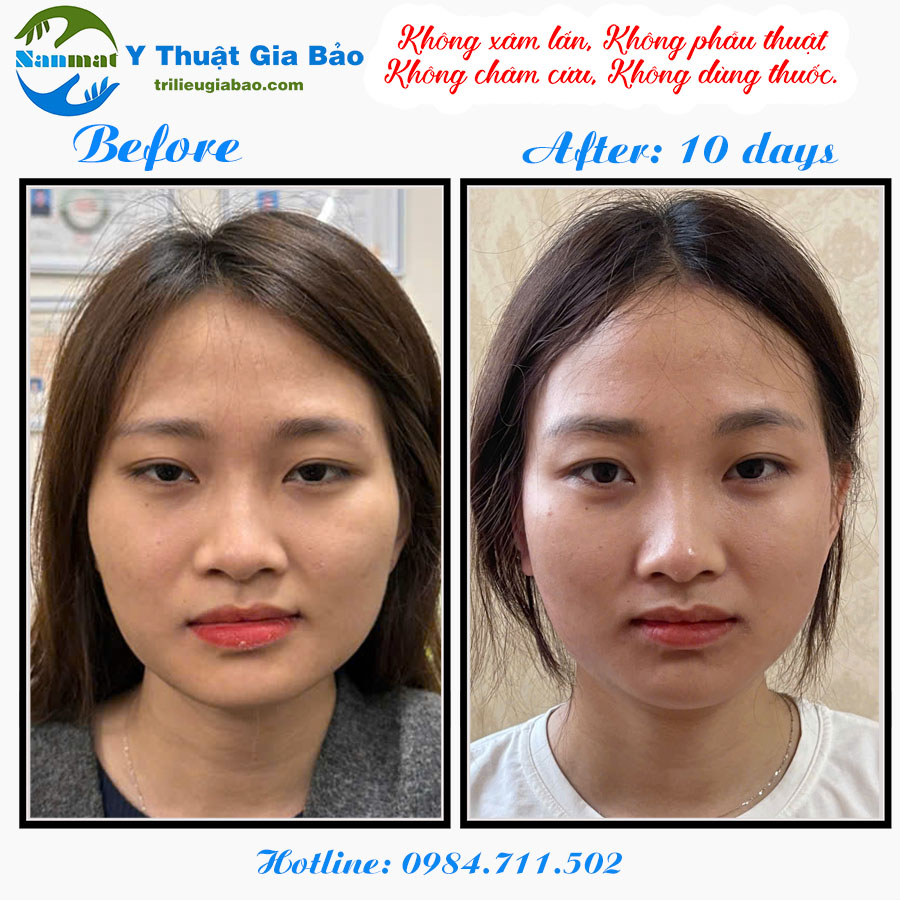 NẮN MẶT LỆCH KHÔNG XÂM LẤN: MS.HUYỀN SAU 10 BUỔI NẮN CHỈNH
