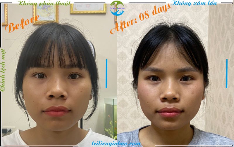 Nắn mặt lệch không xâm lấn: Ms. Dung  sau trị liệu 10 buổi
