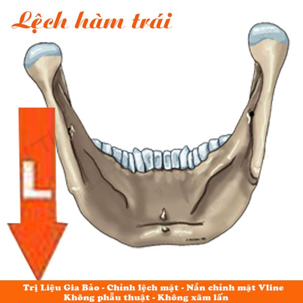 chỉnh lệch hàm không phẫu thuật