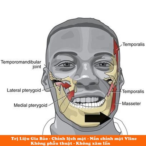 chỉnh lệch mặt không phẫu thuật
