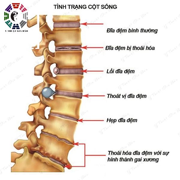 Chữa Gai cột sống không châm cứu