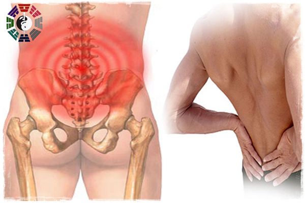Đau thắt lưng có thể lan sang vùng mông
