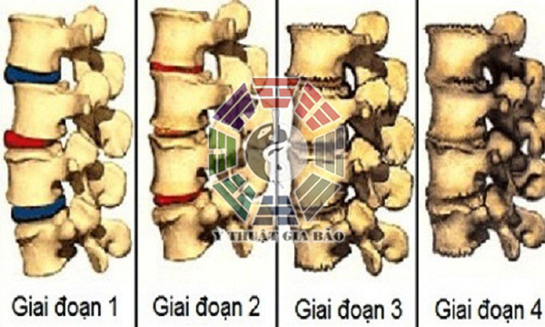 Chữa đau mỏi vai gáy