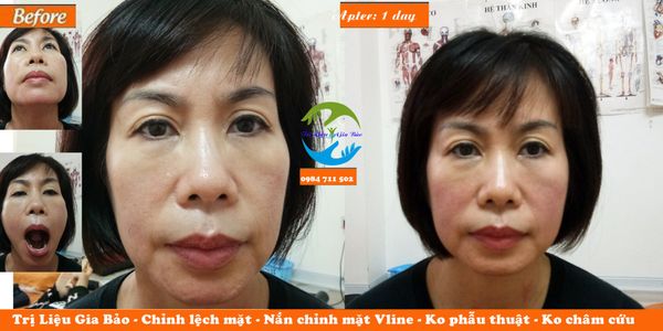 chỉnh lệch mặt không phẫu thuật