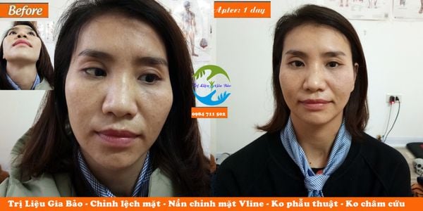 Chỉnh lệch mặt, chỉnh lệch hàm 