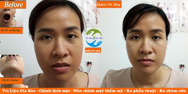 chỉnh lệch mặt không phẫu thuật