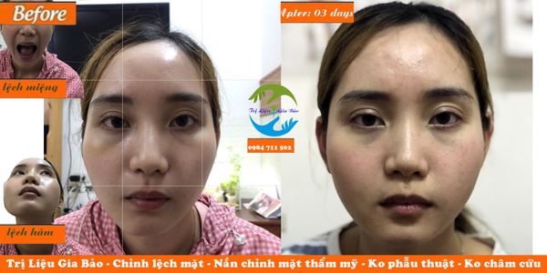 chỉnh lệch mặt không phẫu thuật