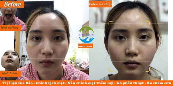 chỉnh lệch mặt không phẫu thuật